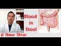 Reason for Blood in Stool : Causes and Treatment in Hindi