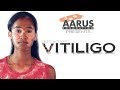 Lets accept vitiligo | Aarus Foundation
