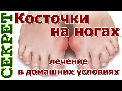 Лечение косточки в домашних условиях Лечение косточки в домашних условиях