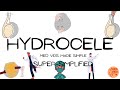 Hydrocele (Embryology, types, clinical features, examination, surgeries) Surgery |MedVidsMadeSimple