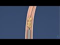 Ureterolitotripsia Rigida - Animação cirurgia de pedra no ureter - Tratamento de cólica renal