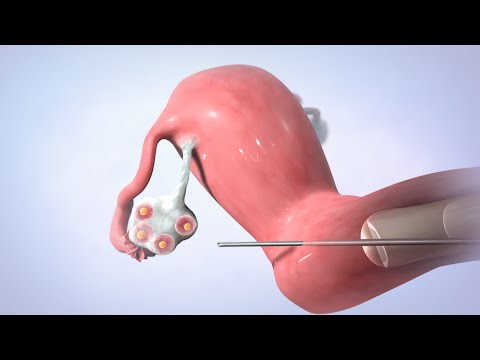 Sex before frozen embryo transfer