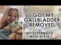 I Got My Gallbladder Removed At 21