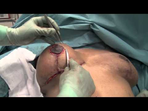 sex efter bröstoperation sex efter bröstoperation