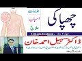 Urticaria | Chapaki ka ilaj in Urdu | Urticaria Treatment in Urdu | Skin Allergy Ka ilaj | Allergy
