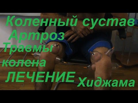 Хиджама на коленном суставе Хиджама на коленном суставе