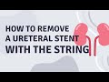 How to remove a ureteral stent on a string