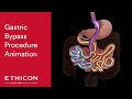 Gastric Bypass Procedure Animation