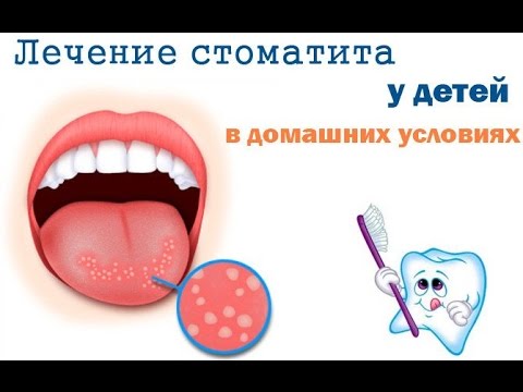 Как выглядит стоматит во рту чем лечить у детей Как выглядит стоматит во рту чем лечить у детей