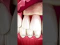 The Surgery To Reveal More Teeth 😨