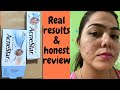 Acnestar Gel & Acnestar soap Review & results. HOW TO GET RID OF ACNE FAST. Pimples, blackheads