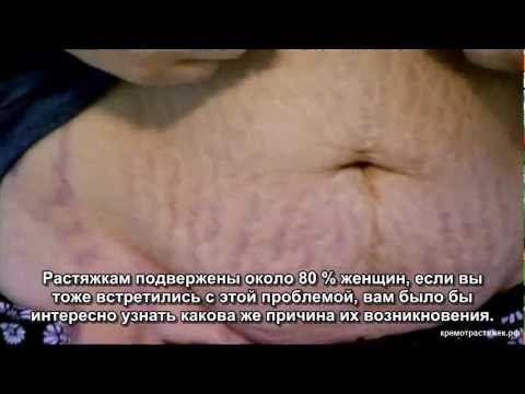 Что делать если растяжки в подростковом возрасте Что делать если растяжки в подростковом возрасте