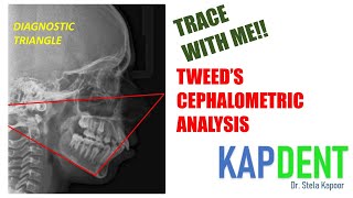 Tweed's Cephalometric Analysis | Trace with me | #orthodontics #kapdent #dentistry