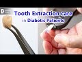 Can diabetic patient get his tooth extracted? | Precautions & Tips- Dr. Syed Yunus | Doctors' Circle