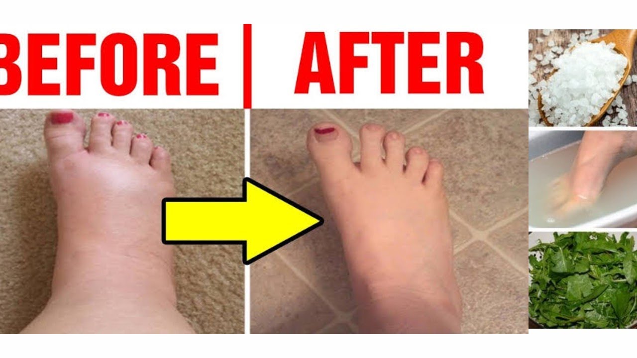 Natural Best Home Remedies For Swollen Feet & Ankle_Pedal Edema,How To ...