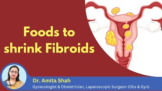 How to shrink the growth of fibroids? | Fibroid shrinking foods | Dr. Amita Shah