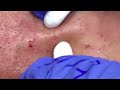 blackheads extractions “k’s” 3rd treatment