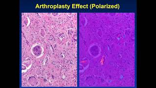 Kilpatrick Periprosthetic Joint Infection