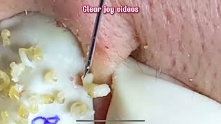 Big Cystic Acne Blackheads Extraction Blackheads \u0026 Milia, Whiteheads Removal Pimple Popping