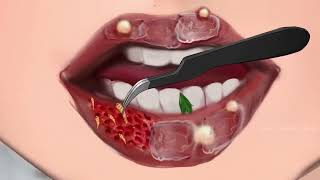 ASMR Lip Treatment infected parasiticwounds & Soles Deep Cleaning | SeverelyInjured Animation
