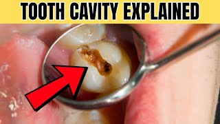 You’re Brushing Every Day… But Still Getting Cavities? Here’s Why!