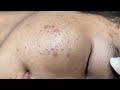 ACNE TREATMENT VU QUYNH MI | Perennial Blackheads On Teen Face 2024(FULL)