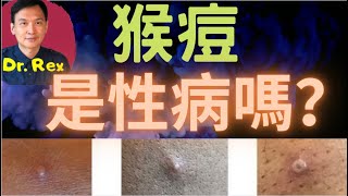 (中英字幕EngSub)猴痘傳遍13國，是變種了傳染性增加？ 是性病嗎？ Is a new mutation driving the monkeypox outbreak? Is it a STD?