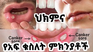 በየግዜው የሚከሰት የአፍ ውስጥ ቁስለት/ ህክምናው/ አጋላጭ ነገሮች