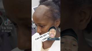 She Got Forehead Reduction Surgery This Happened