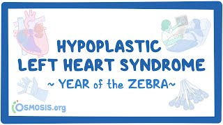 Hypoplastic left heart syndrome (Year of the Zebra 2024)