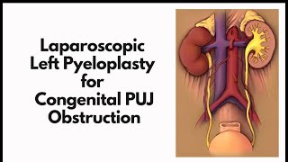 Lap pyloplasty for congenital PUJ obstruction