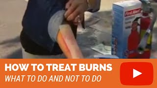 How To Treat Burns (2nd degree, 3rd degree burns)