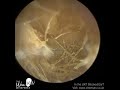 1 154 stuck woven ear hairs nest removed off infected eardrum