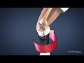 what is the acl and how does it work acl series