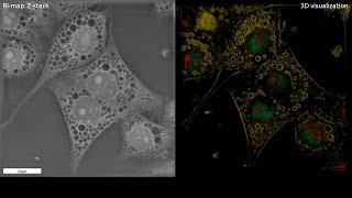 Lysosomal Storage Disorders LSD and 3D microscope