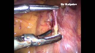 Laparoscopic Uterosacral Ablation with Presacral Neurectomy for Chronic Pelvic Pain