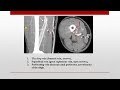 US & Doppler Examinations of LE veins