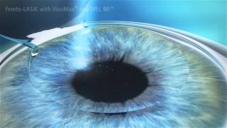 Augenlasern mit dem Verfahren Femto-Lasik