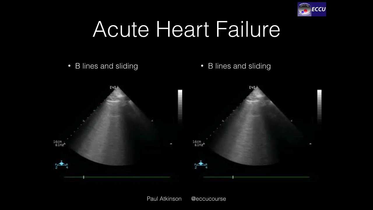 B Lines And Heart Failure - YouTube