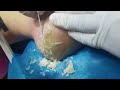 so satisfying. cracked heel treatment. dead skin removal. massive dead skin was cutted off.