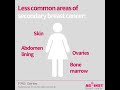 faq series what is secondary spread breast cancer