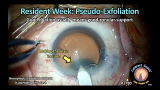 CataractCoach™1780: resident week: pseudo-exfoliation