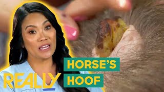 Dr. Lee Removes A “Horse's Hoof” Like Bump From Patient’s Head | Dr. Pimple Popper