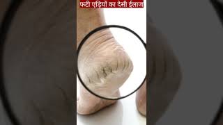 फटी एड़ियों का देसी नुस्खा। #short #shortvideo #youtubeshort #viralshort #Nehabehealthy