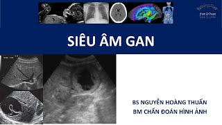 Siêu âm gan - Phần 1 - Giải phẫu - Mặt cắt