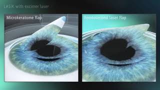 ZESIS - LASIK Treatment Animation splitscreen EN 34 160 0004I 1