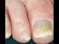 Warts vs Toenail Fungus nasty but cureable!