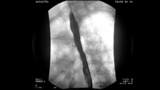 Modified Barium Swallow Case Study - Michael Groher | MedBridge