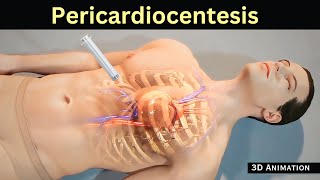 Pericardiocentesis | removing excess amount fluid from pericardium