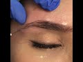 eyebrow lift using filler with jason emer md